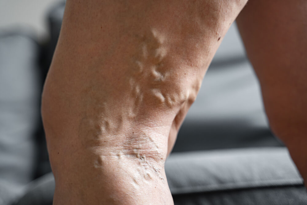 Close-up of a leg showing pronounced varicose veins under the skin.