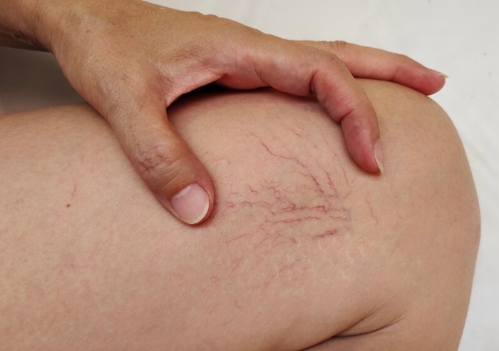 Close-up of a person's hand gently touching spider veins on the thigh.