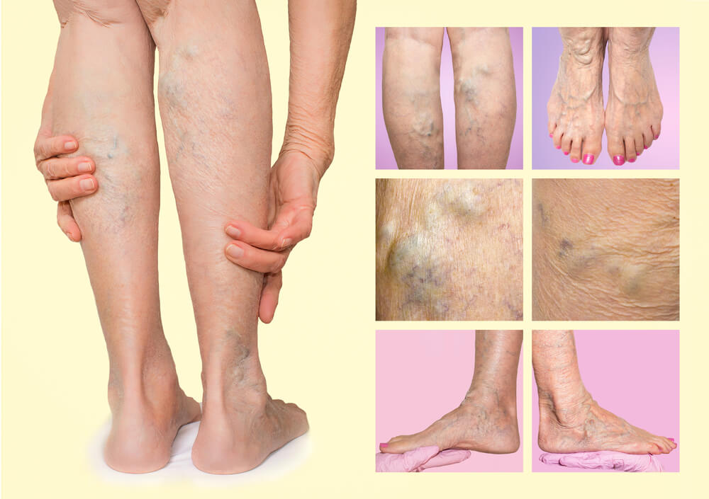 Spider Veins vs. Varicose Veins: What You Need to Know