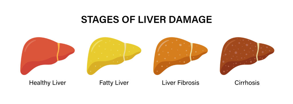 Stages of liver damage