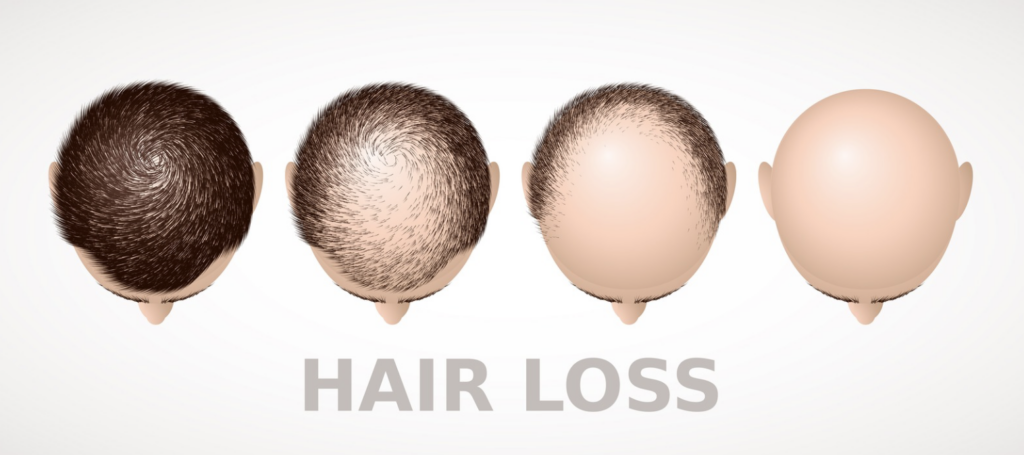 Back view of a man with visible thinning hair on the crown, with a close-up illustration showing hair follicles beneath the scalp