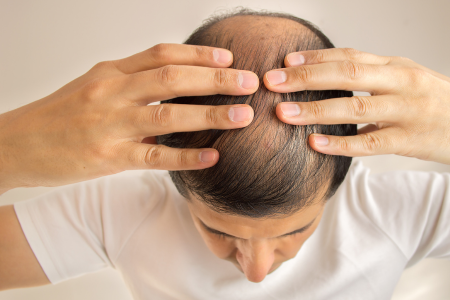 Back view of a man with visible thinning hair on the crown, with a close-up illustration showing hair follicles beneath the scalp