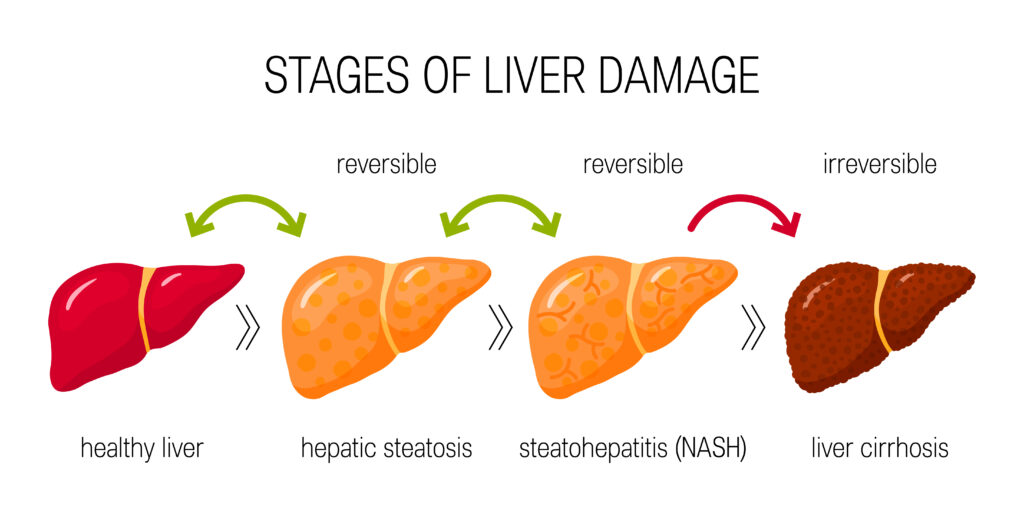 Stages f liver damage image