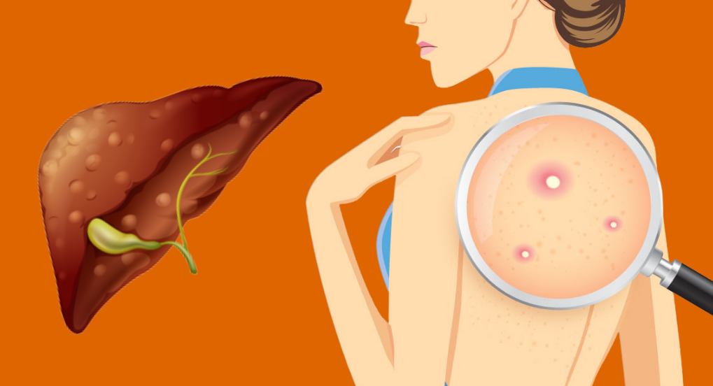 Liver health issues, pimples on women's back.